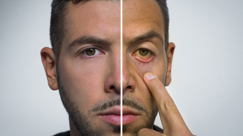 Split image of man's face healthy and with jaundiced skin and eye.