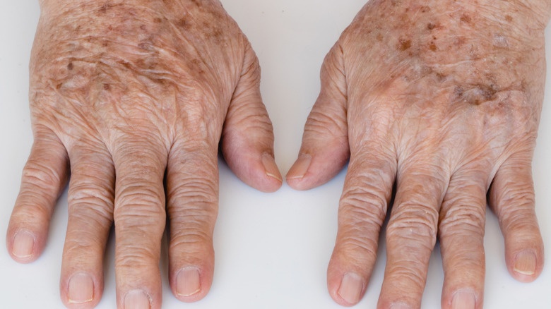 Hands with liver spots.