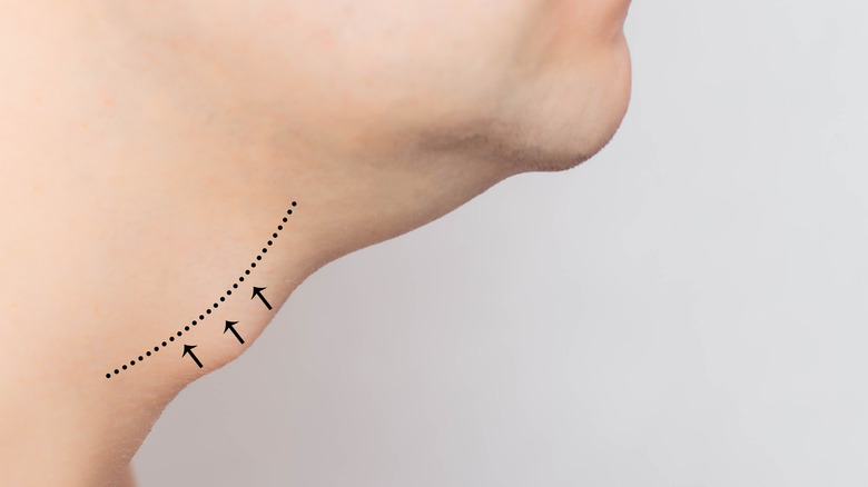 a person's Adam's apple with markings on it for surgery