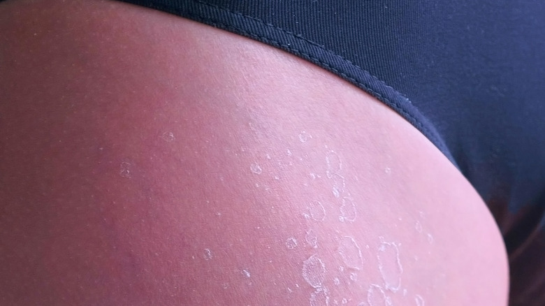 closeup of woman's sunburnt legs