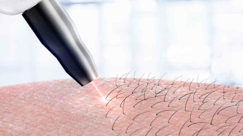 laser applied to skin with body hair