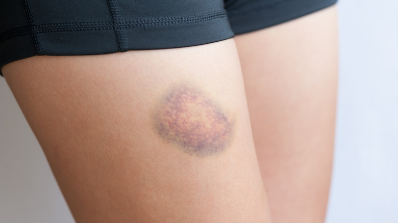 Close up of a bruise on a person's leg