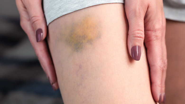 A person with painted nails holding their bruised leg