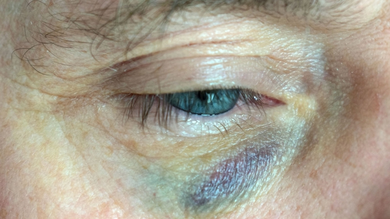 bruised eye