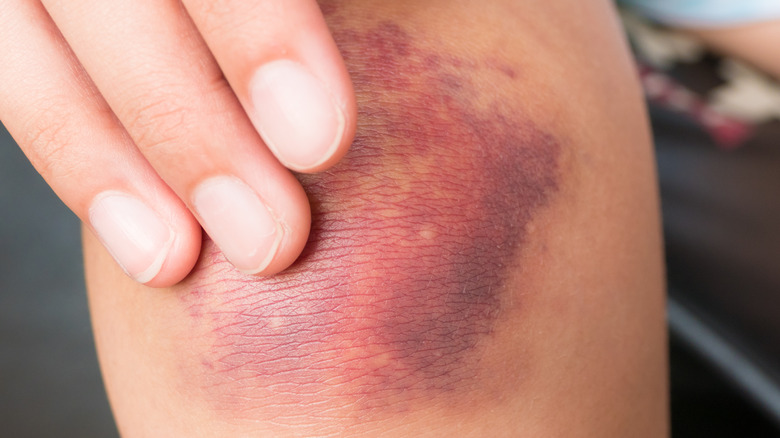 A closeup of a hand touching a multicolored bruise