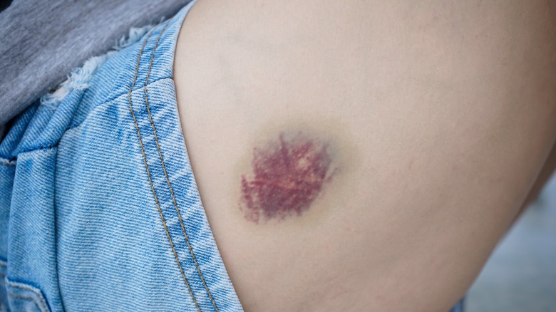 Closeup of a bruise on a person's leg
