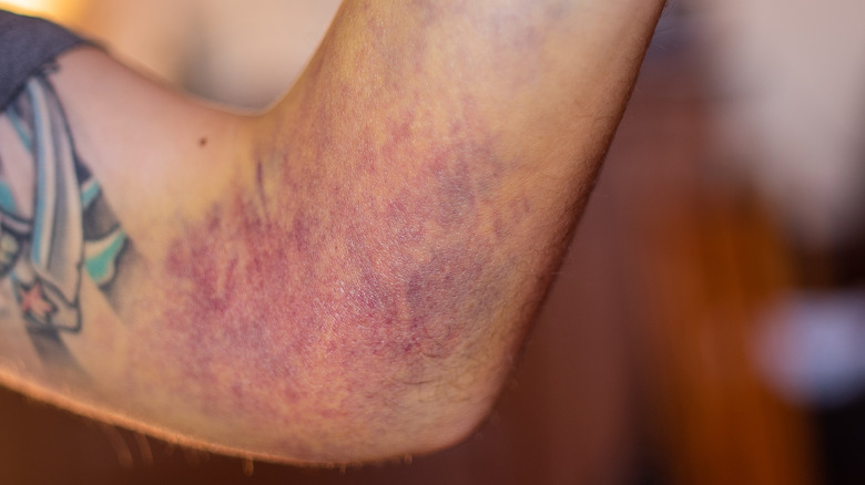 Person holds up their arm to display a severe bruise