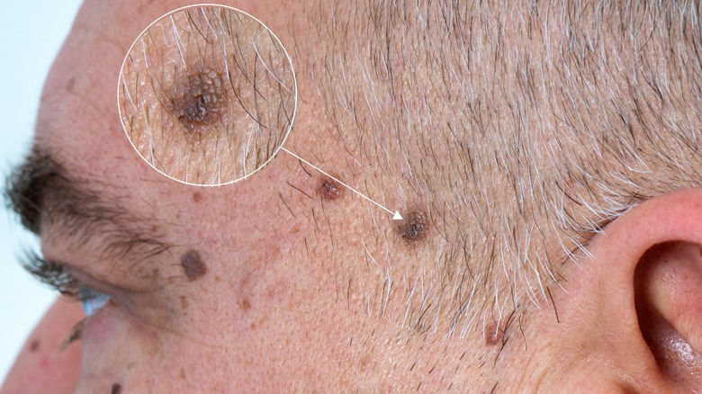 man with face moles