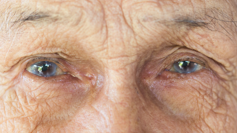 Eyes with cataracts