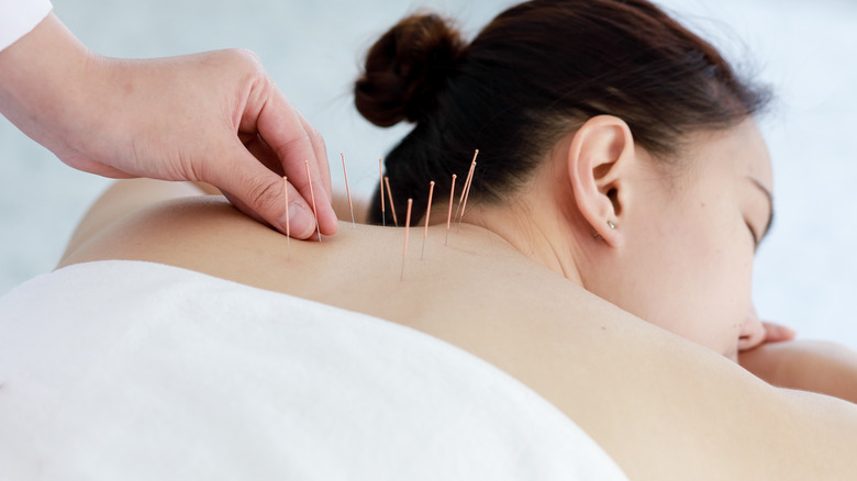 Woman asleep and undergoing acupuncture 