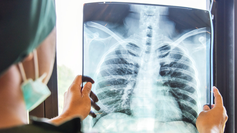 doctor holding x-ray of lungs