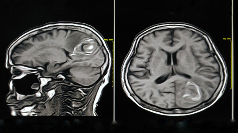 MRI images of brain cyst