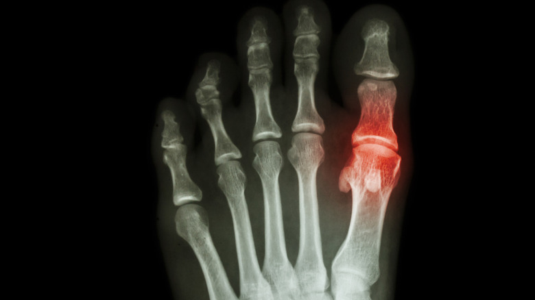 x-ray of foot with inflammation at MTP