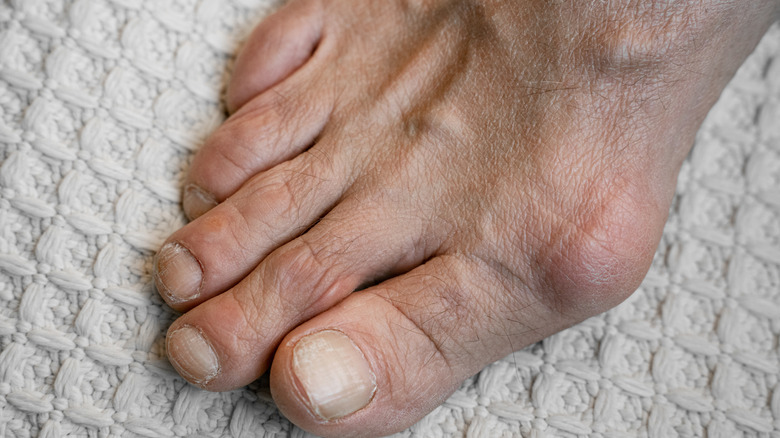 a foot damaged by gout
