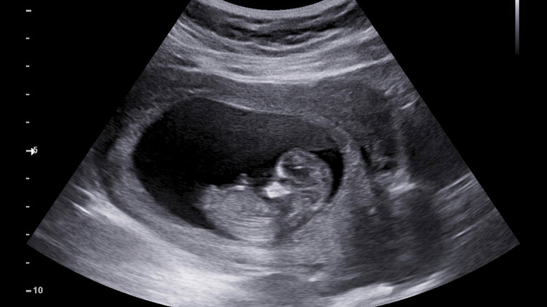 An ultrasound of a fetus as 12 weeks