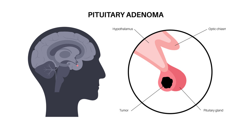 cross-section of brain showing location of pituitary adenoma
