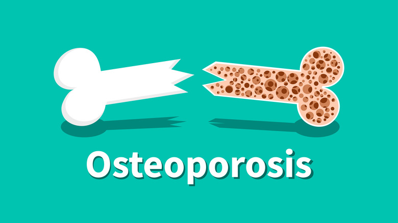 'Osteoporosis' written out below picture of a fractured bone