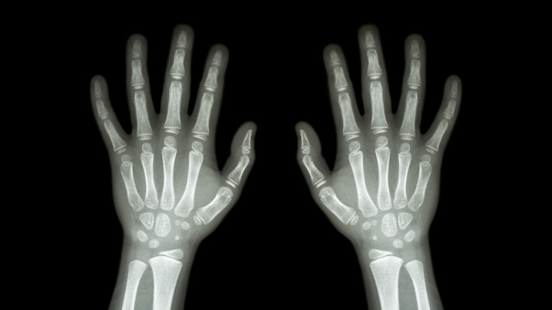 X-ray of child's hands