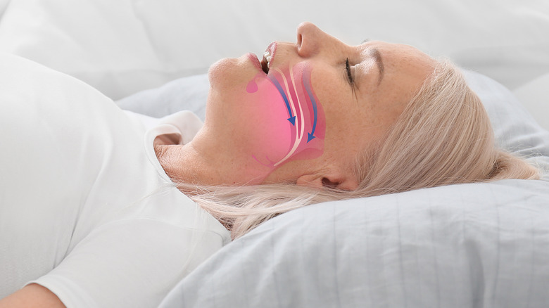 woman sleeping with illustrative arrows showing she has sleep apnea