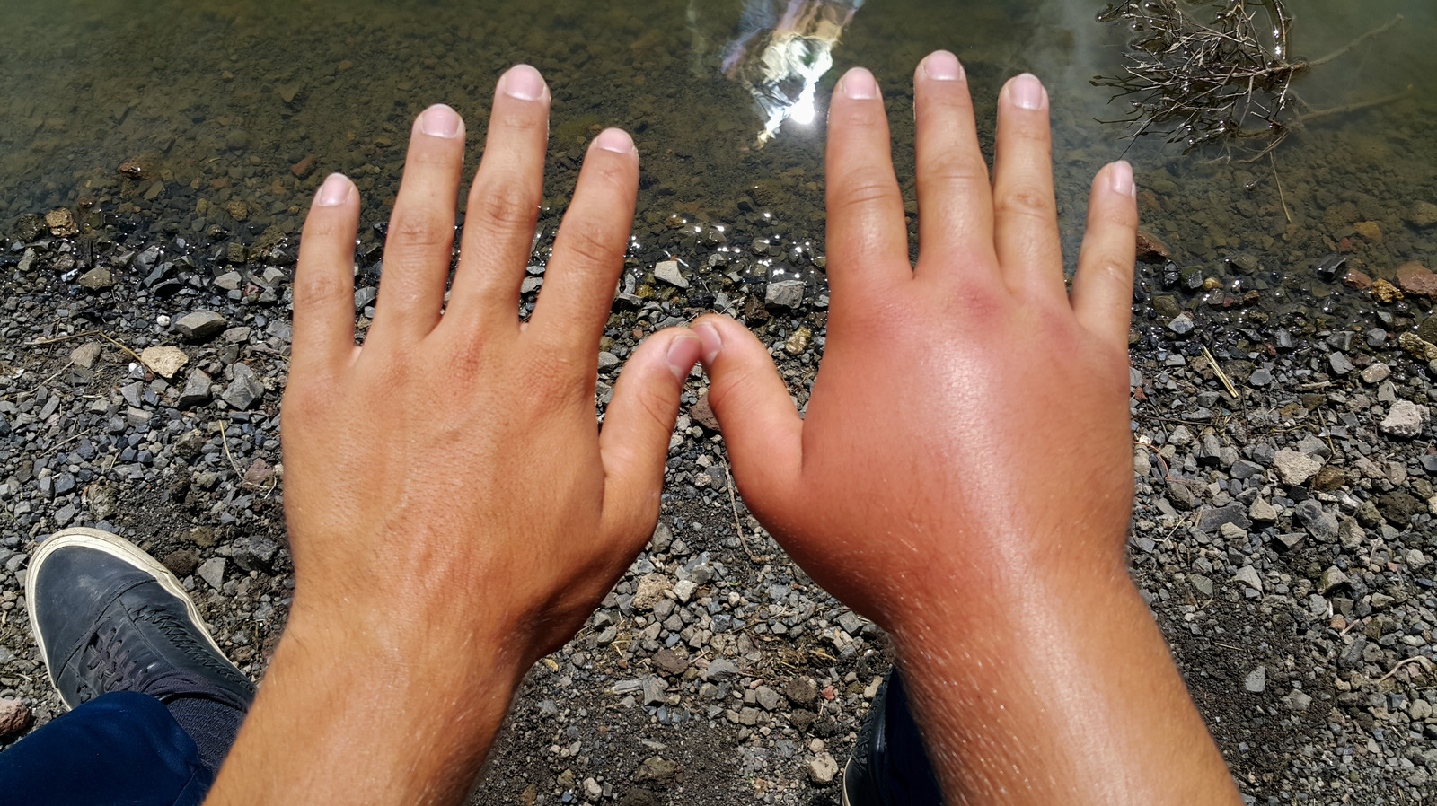 7 Reasons Your Fingers Are Swollen
