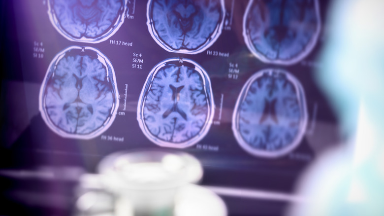 brain scan for Alzheimer's disease