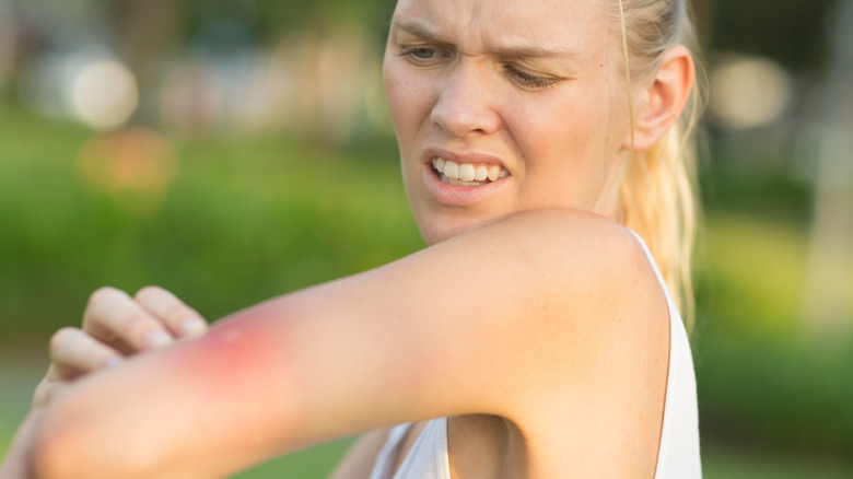 woman with mosquito bite