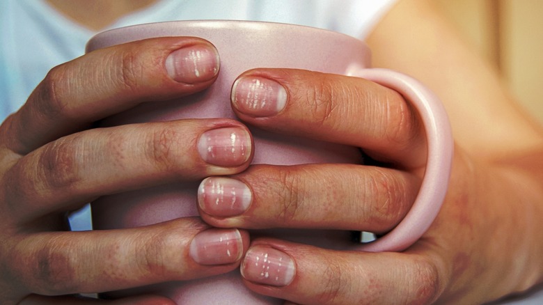 Hands with damaged nails holding coffee mug