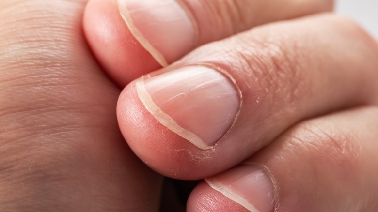 Fingernails with vertical ridges