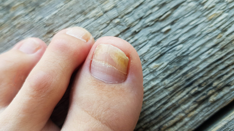 Infected toenails