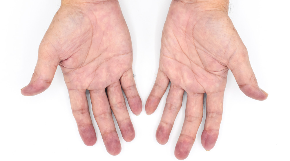 two hands with discoloration