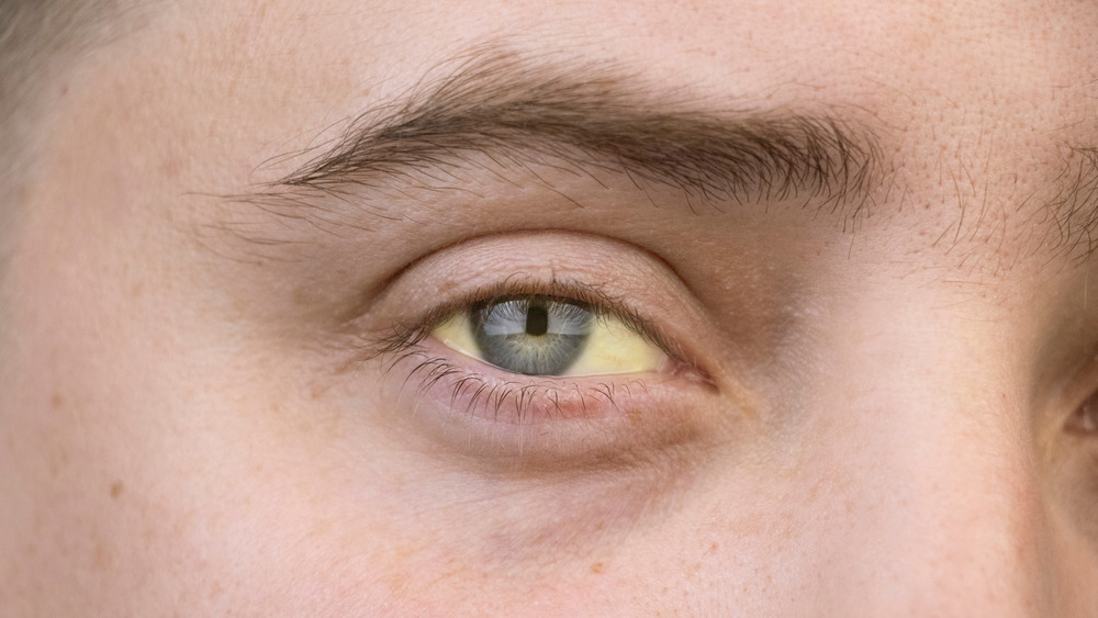 Man with yellow eyes, jaundice