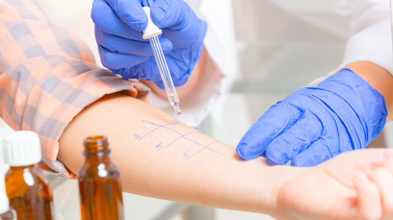 Gloved hands performing an allergy test on a patient's arm with a dropper