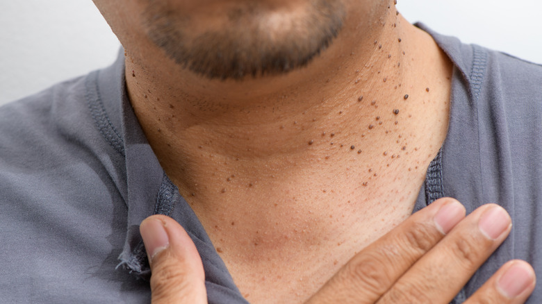 Man with skin tags
