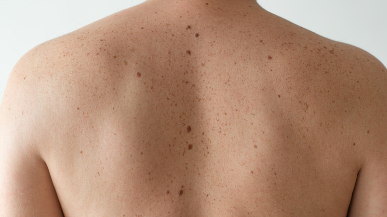 a mans back filled with moles of different sizes 