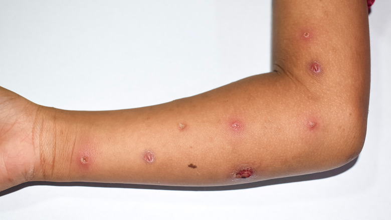 Monkeypox lesions on arm 