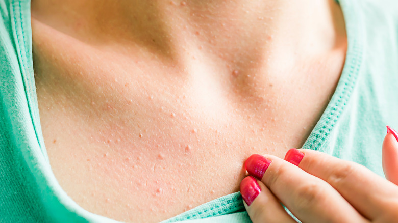 Here's What's Really Causing The Acne On Your Chest