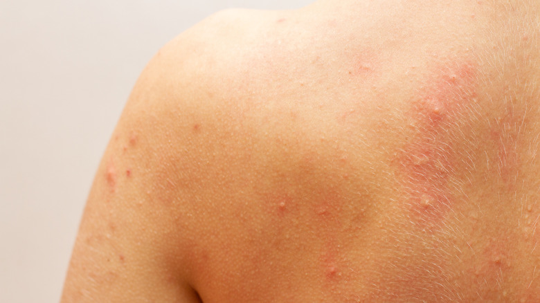 back skin with acne and irritation 