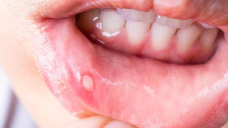 Close up of canker sore
