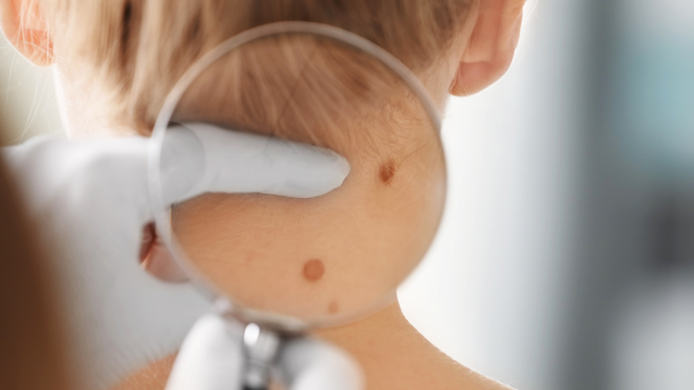 Dermatologist examining woman's birthmark
