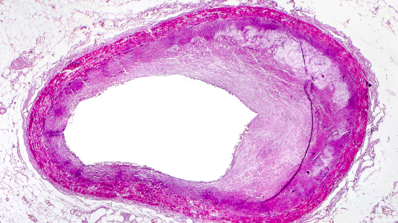 artery with plaque buildup