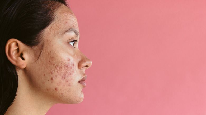 Woman with acne on her jawline and cheeks