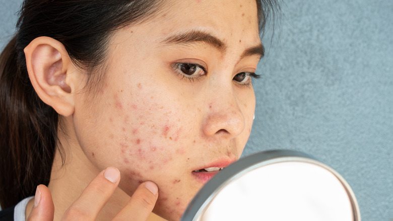 Woman looking at her acne in a hand mirror