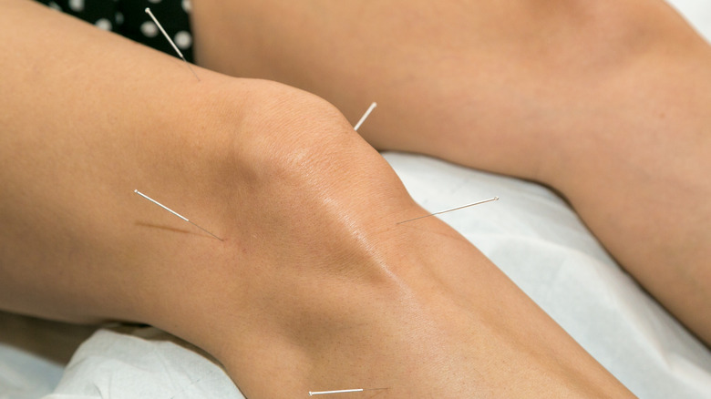 acupuncture in knee