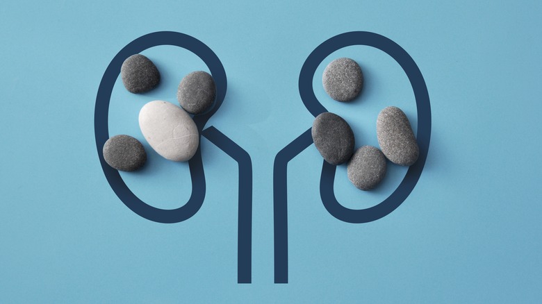 drawing of kidneys with stones inside