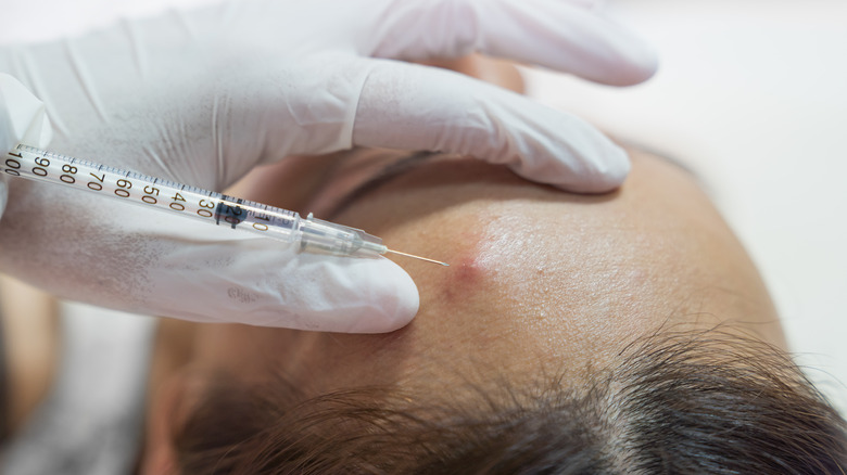 Person receiving acne cortisone injection