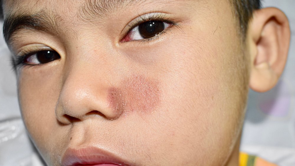 Burmese boy with skin condition