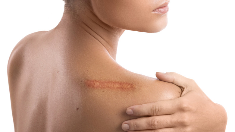 Close up on woman's back shoulder with healed scar wound