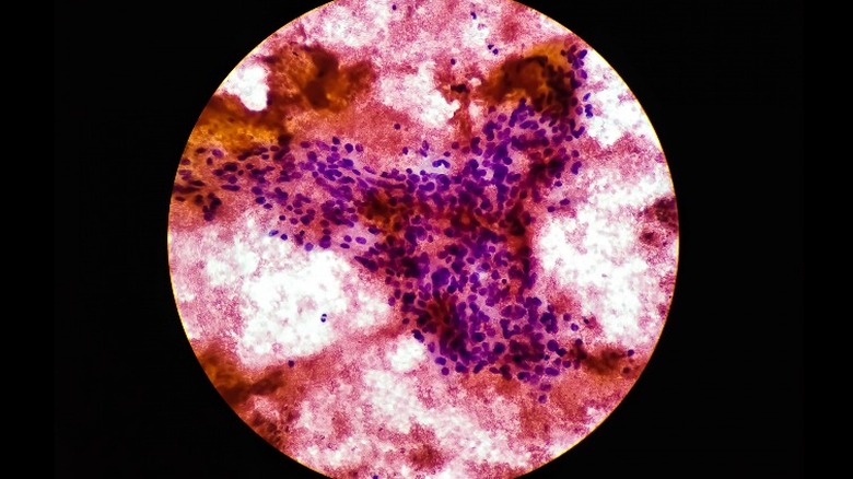 Microscope view of cancer cells spreading