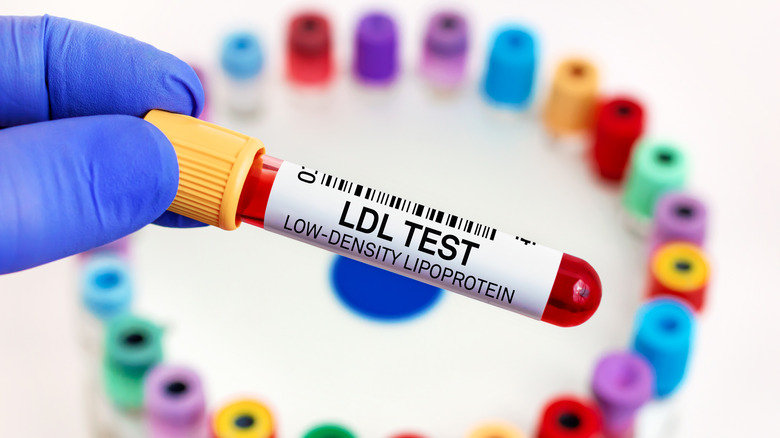 gloved hand holding LDL test vial