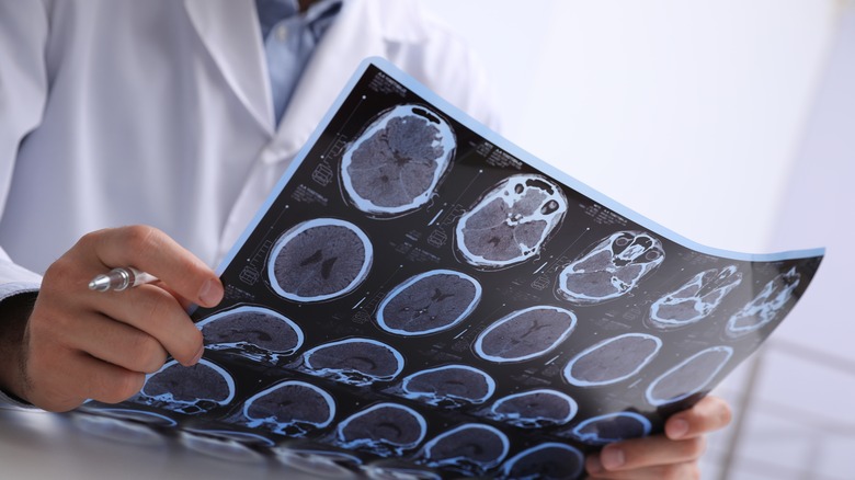 doctor examining brain scan
